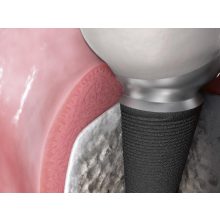 Astra Tech Implant EV OsseoSpeed 4.2 S