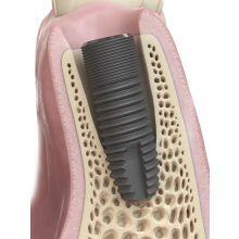 Astra Tech Implant EV OsseoSpeed 5.4 S